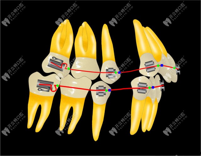 針對(duì)于重度錯(cuò)頜畸形的Tweed-Merrfield定向力矯正技術(shù)有何特點(diǎn)