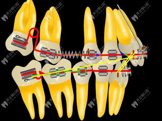 定向力矯正技術過程示意圖