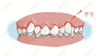 傳統(tǒng)方式需要擴弓來矯正