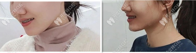 一年半后矯正效果——側(cè)顏好點(diǎn)哦