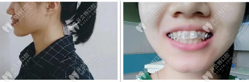 牙套兩個(gè)月側(cè)臉，嘴還是突