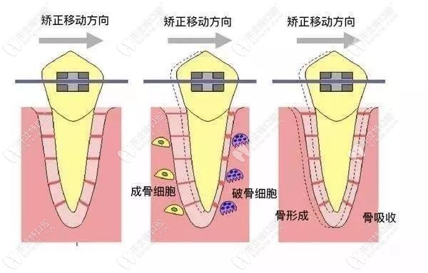 牙齒矯正時的移動方向
