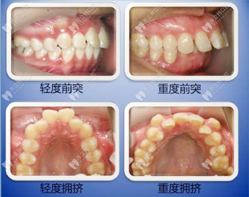 什么情況下需要拔牙才能矯正牙齒？