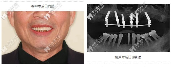 典型重度牙周炎種植案例:如何實現(xiàn)即刻種植與即刻修復？