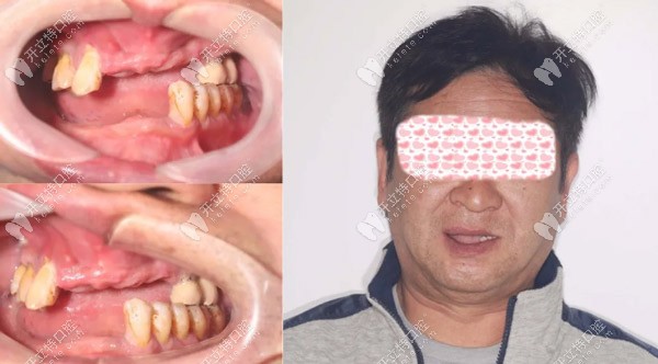 梁先生術前口內情況