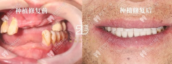 梁先生種植修復前后對比