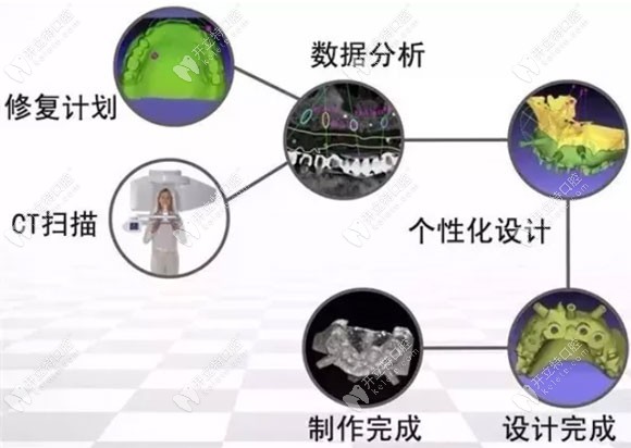 3D導板數(shù)字化種植牙展示圖