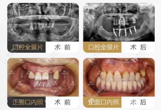 羅薩蒂做all-on-4案例圖