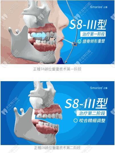 正雅S8、S9、S10頜位重建術