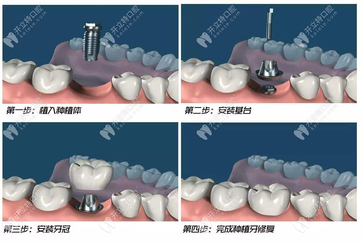 種植牙操作流程