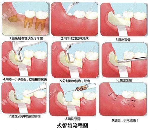 拔智齒的過(guò)程示意圖