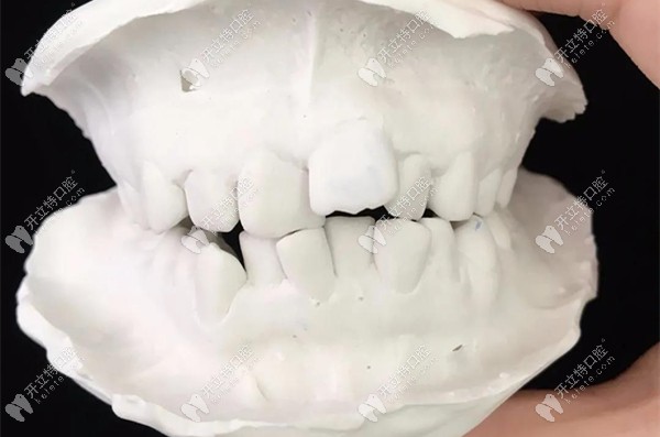 正畸前的牙齒模型