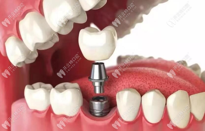 種植假牙修復(fù)技術(shù)