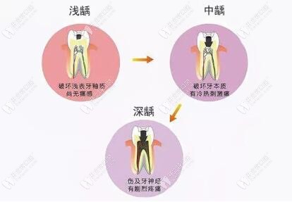 齲齒發(fā)展過程