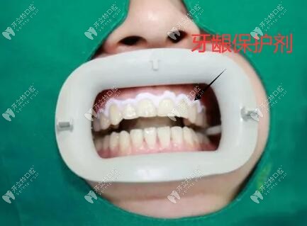 牙齒美白涂抹牙齦保護(hù)劑