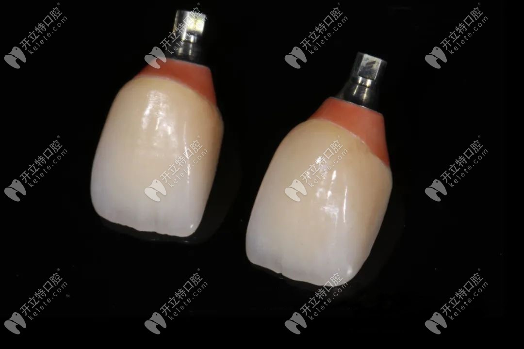 種植后長(zhǎng)久性牙冠的修復(fù)